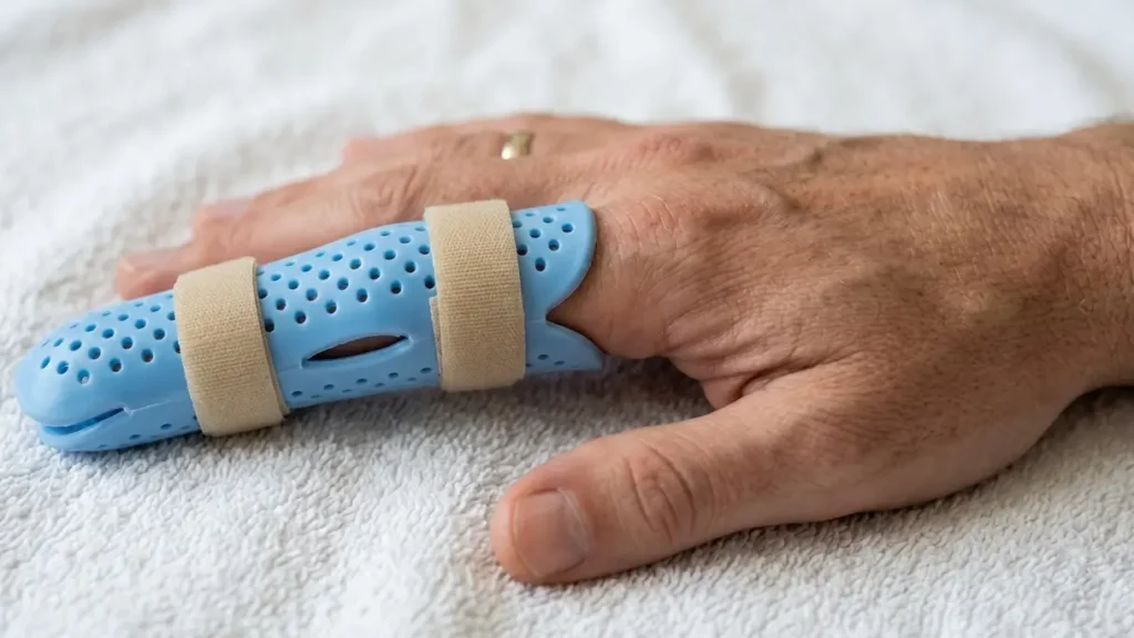 Ayurvedic Management for Trigger Finger