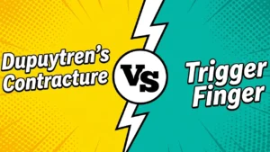 dupuytren's contracture vs trigger finger