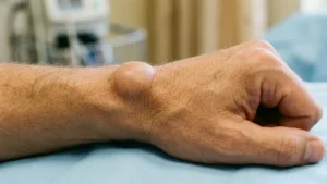 ganglion wrist surgery