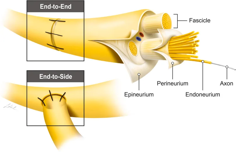 Nerve Transfer