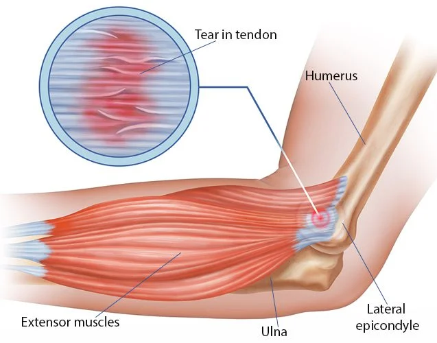 Ulnar Wrist Pain and TFCC Partial Tears