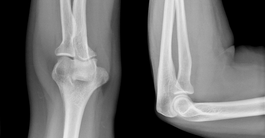 De Quervain Tenosynovitis