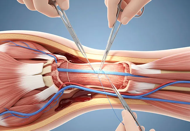 Tendon Repair
