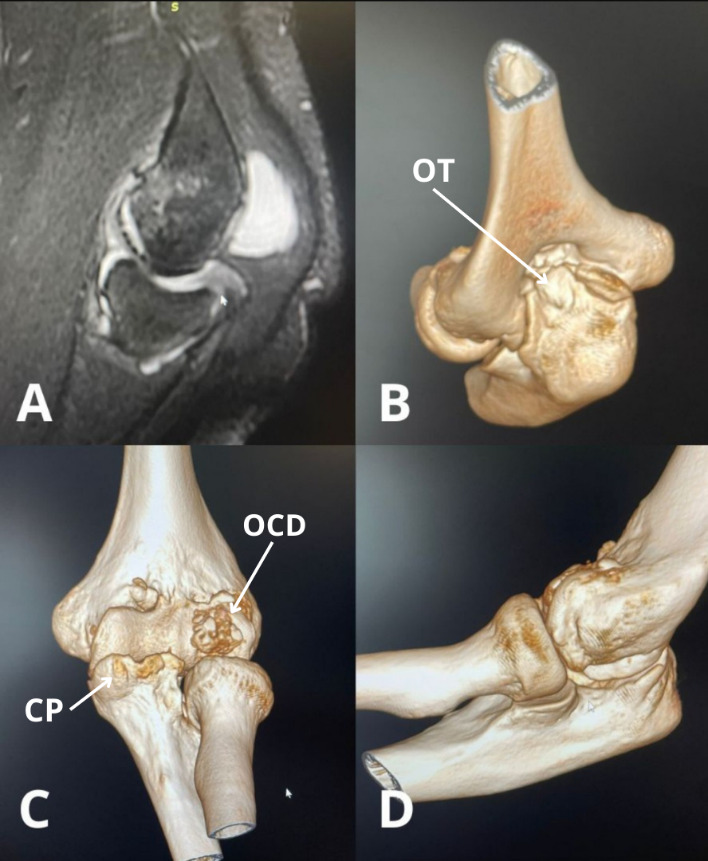 Heterotopic Ossification