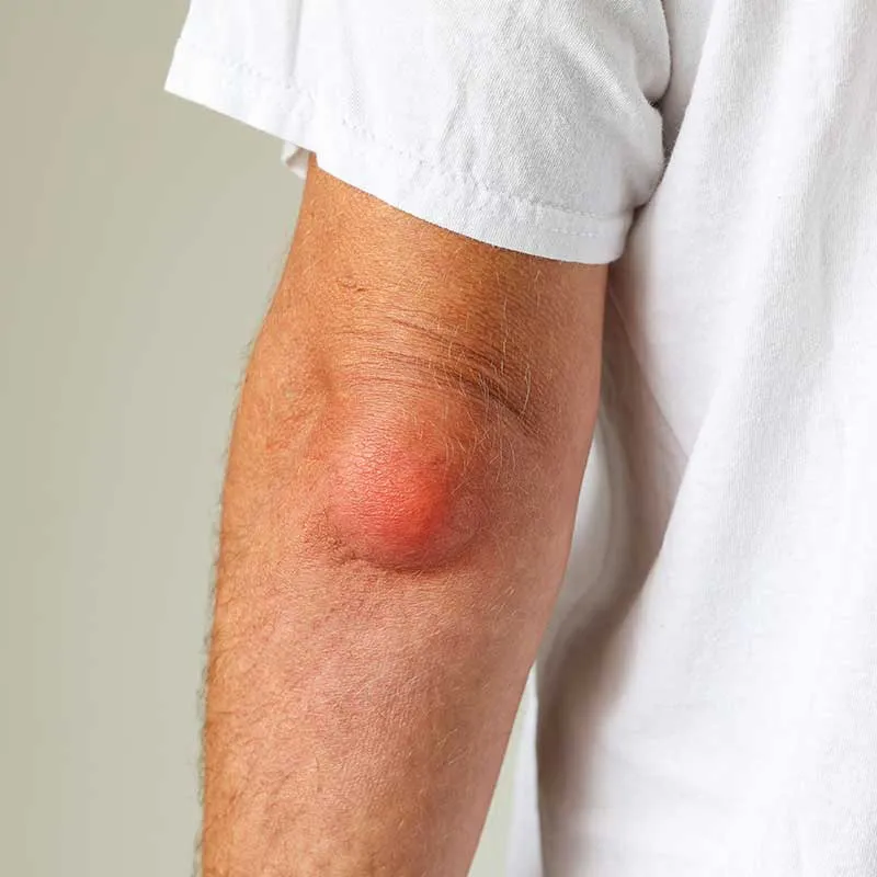 Elbow Arthritis