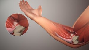 Thrower's Elbow Injury