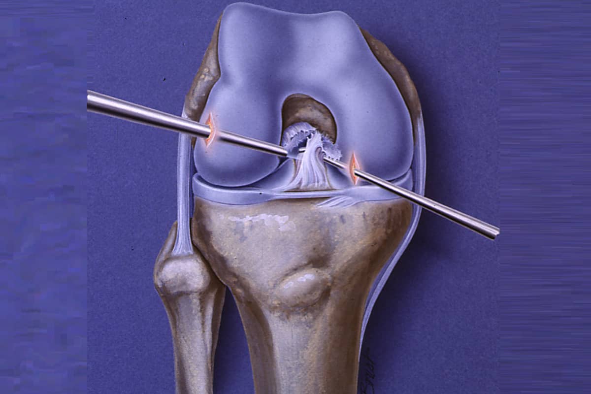 Corrective Osteotomy