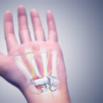  Carpal Tunnel Syndrome UAE: Your Guide to Expert Diagnosis & Treatment