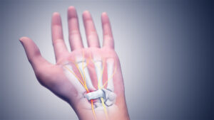 Carpal Tunnel Syndrome UAE