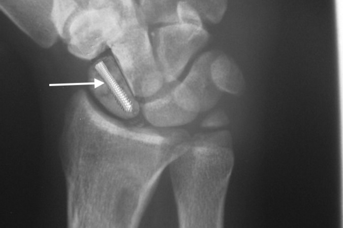 Wrist fracture medical assessment
