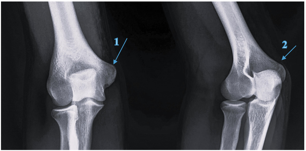 Posterolateral Rotatory Instability X-ray