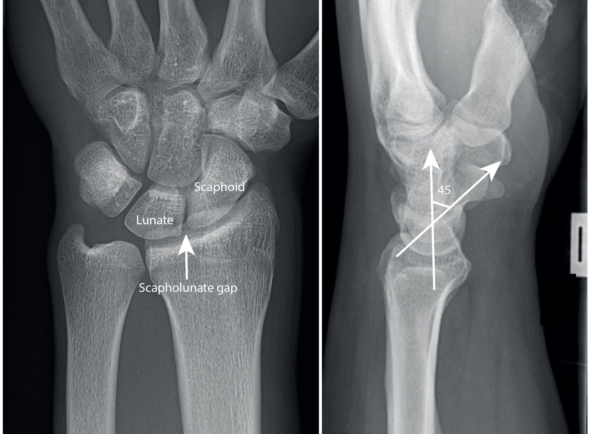 Non-union wrist fracture consultation