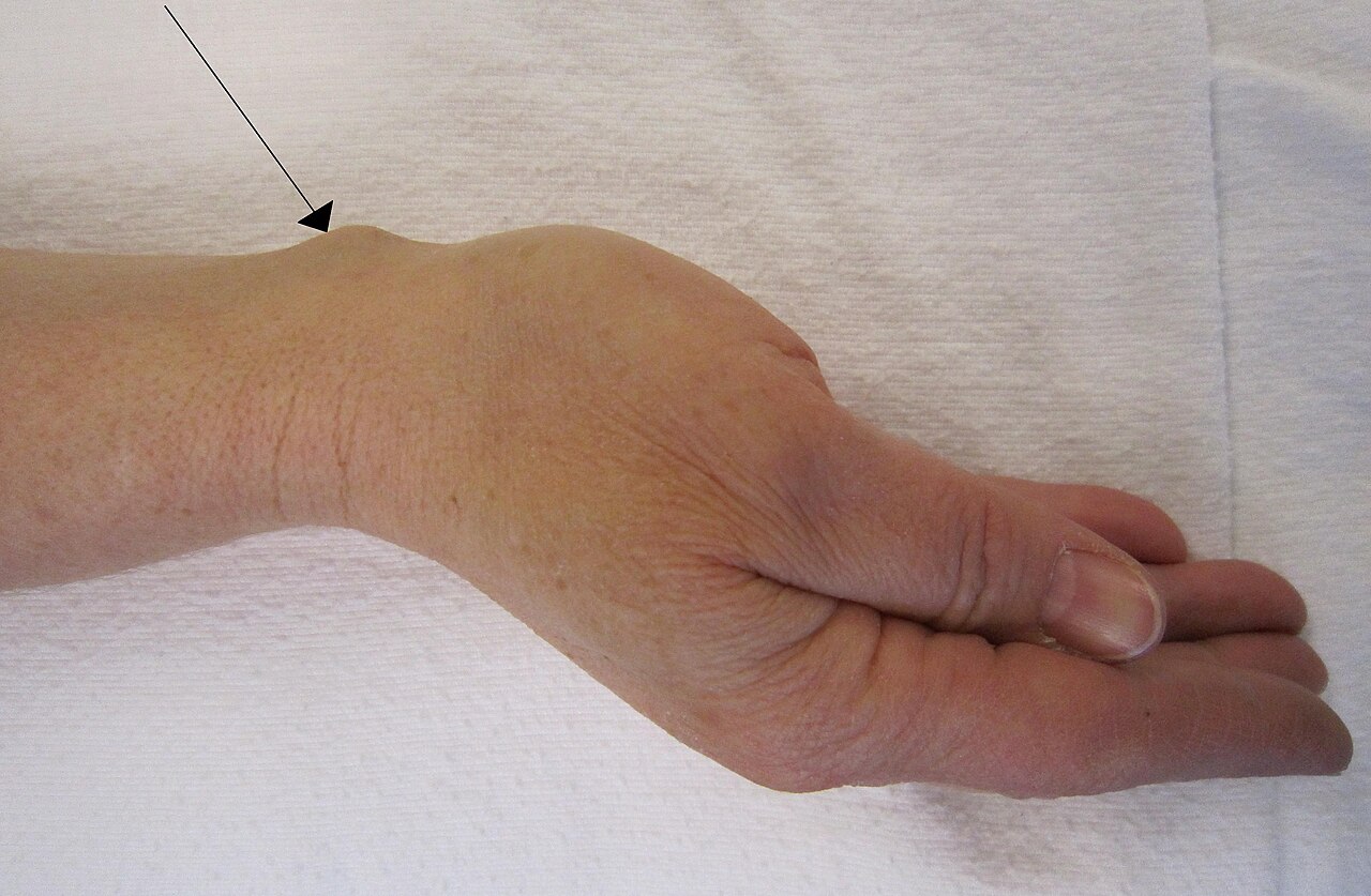 Clinical view of a ganglion cyst on the back of the wrist