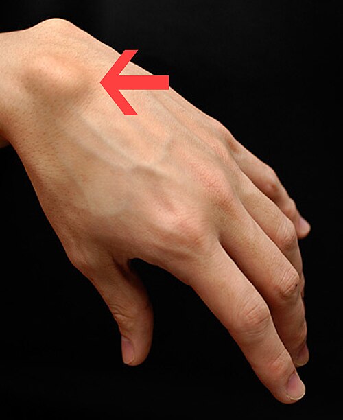 Clinical view of a dorsal ganglion cyst on the back of the wrist