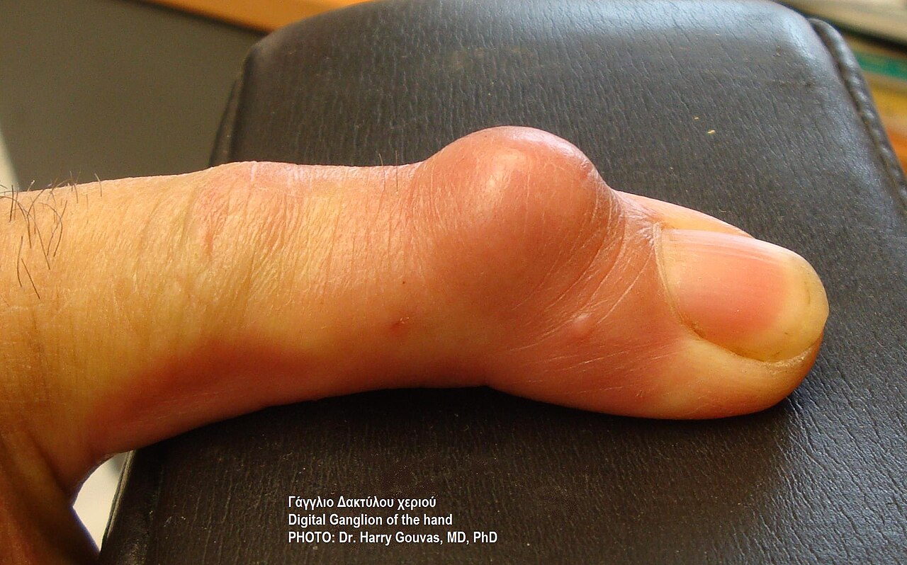 Clinical view of a ganglion cyst at the base of a finger