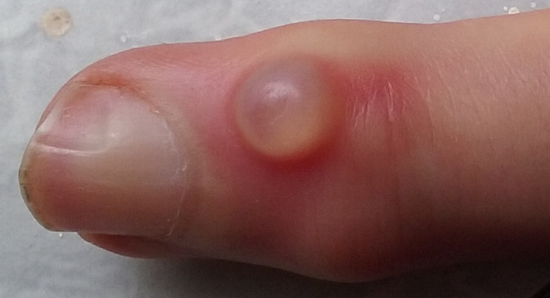 Clinical view of a digital mucous cyst near the end joint of a finger