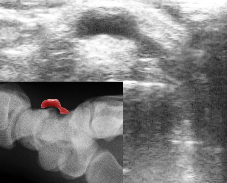 Ultrasound scan showing a ganglion cyst arising at the wrist