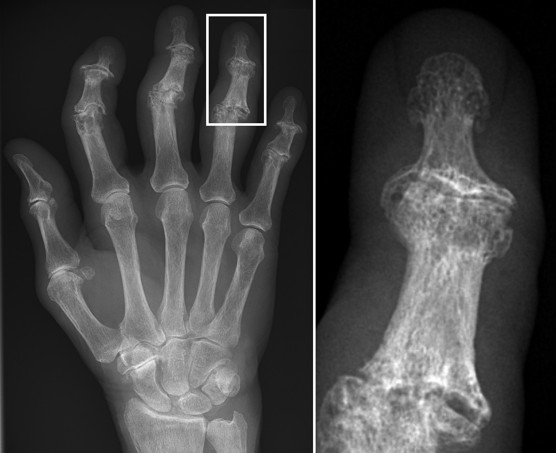Hand X-ray showing osteoarthritis affecting the finger joints