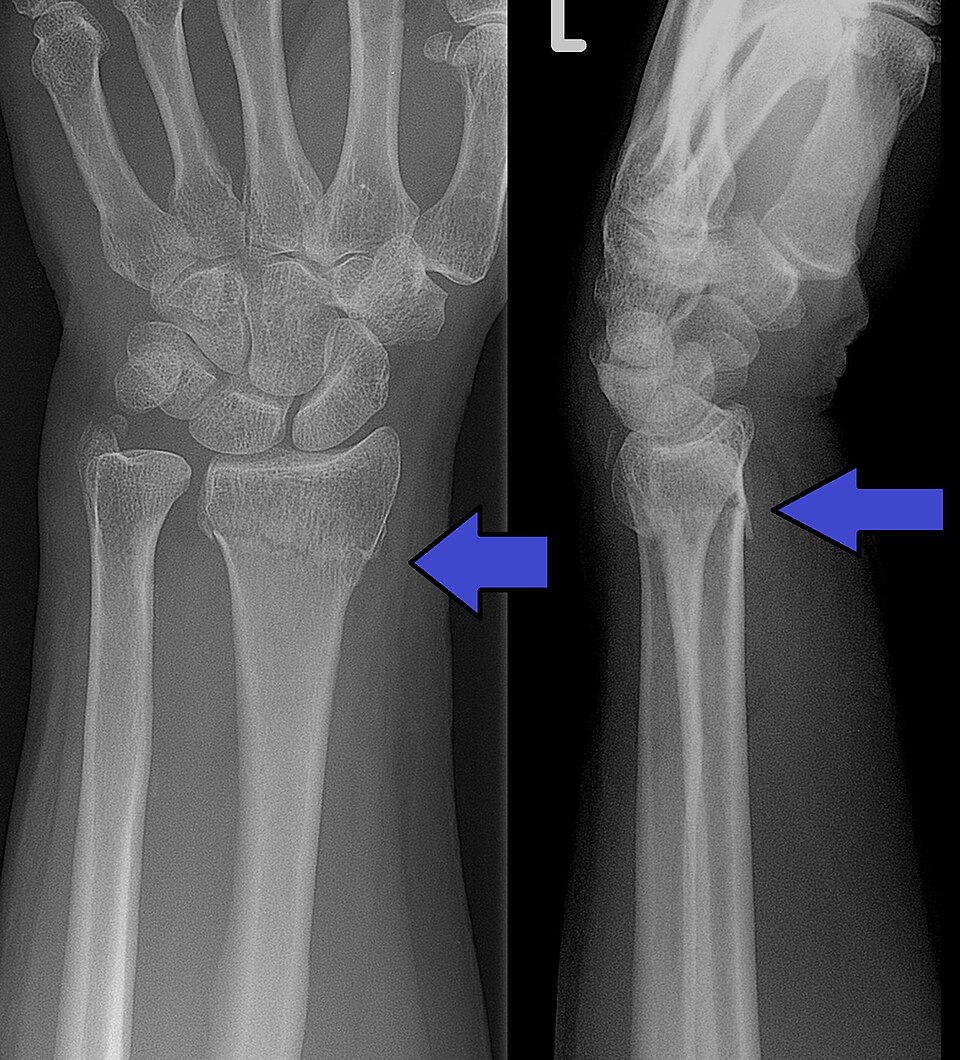 Clinical wrist X-ray showing a previous distal radius fracture