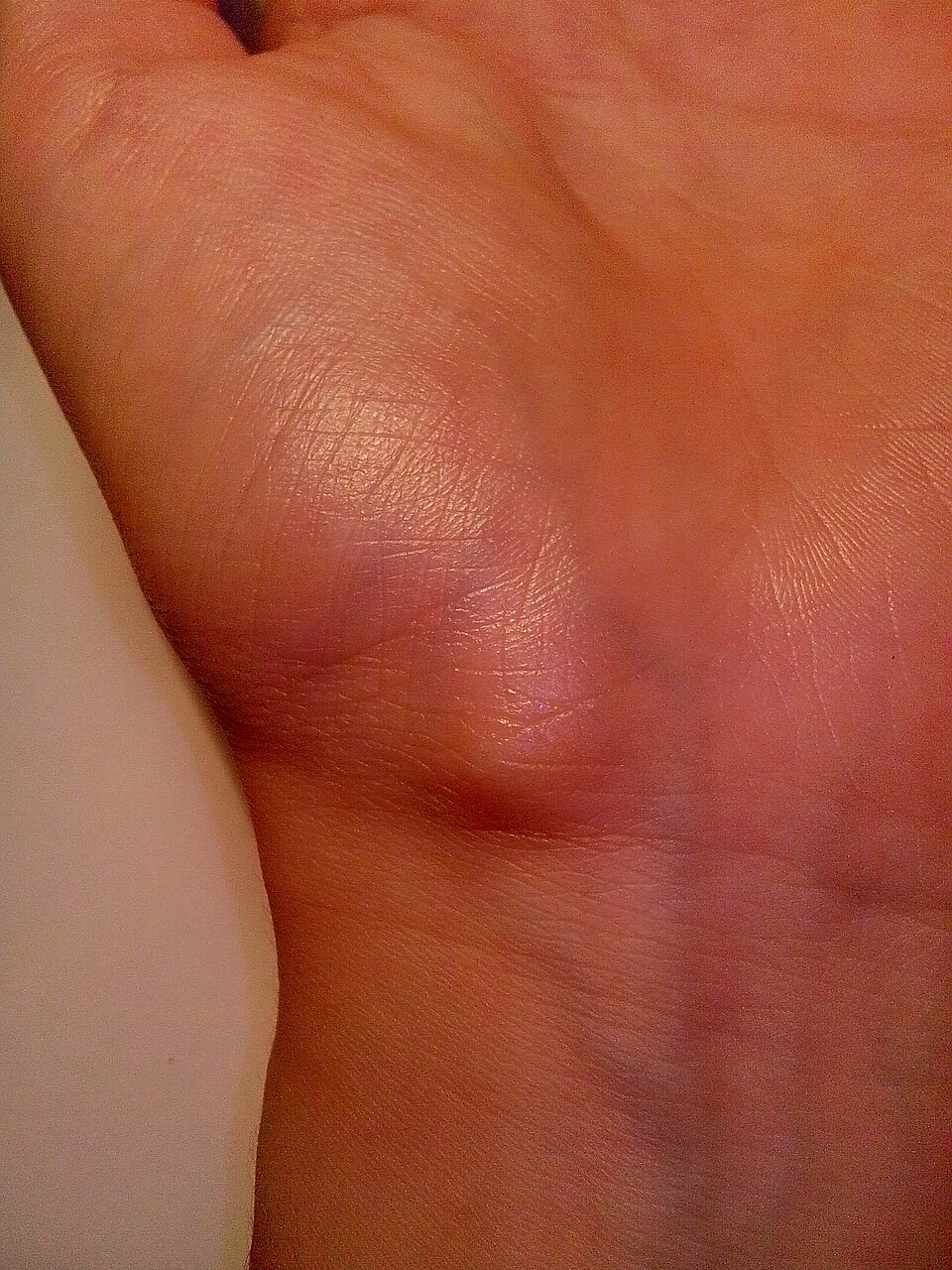 Clinical view of a volar ganglion cyst on the palm side of the wrist