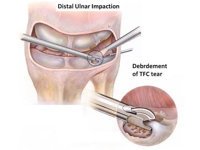 Clinical wrist evaluation for TFCC tear